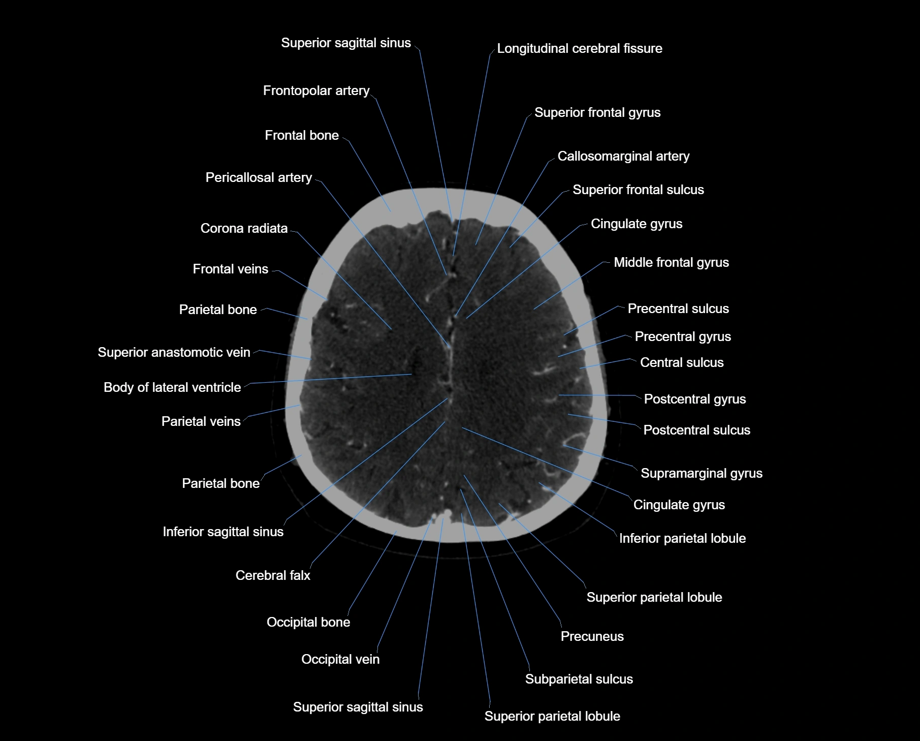 CT scan brain axial labelled cross sectional anatomy image-img-000050.webp